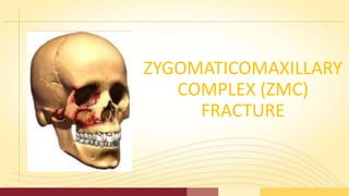 Zmc fracture | PPT