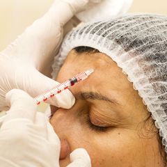 Botox glättet Zornesfalten über der Nasenwurzel