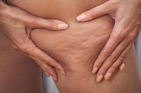 Cellulite entsteht häufig am Po