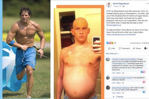 David Fajgenbaum links gesund beim Sport, rechts mit aufgeblähtem Bauch und Glatze während der Chemotherapie