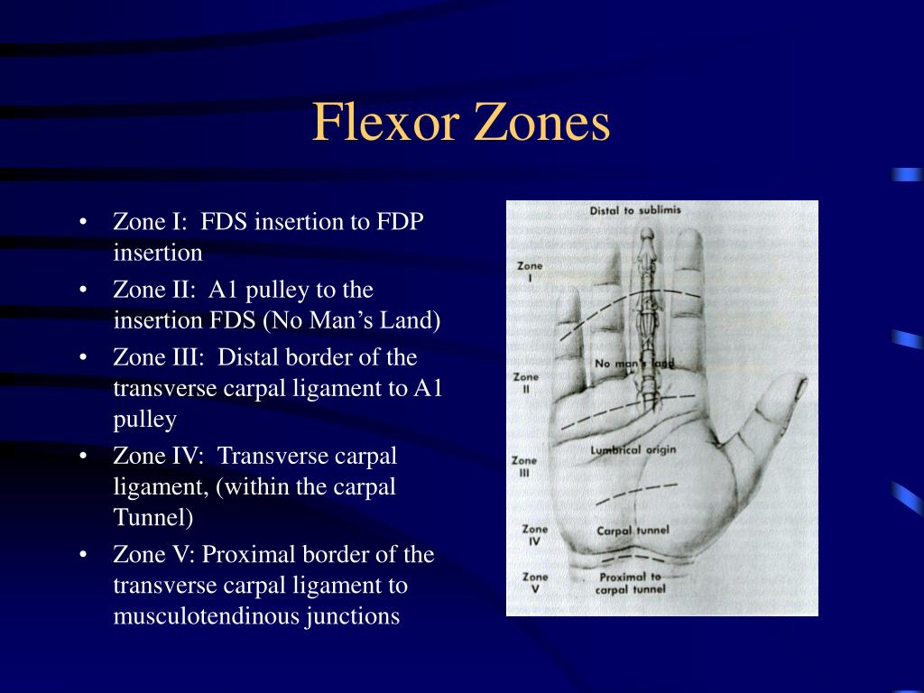 Thumb Flexor Tendon Zones