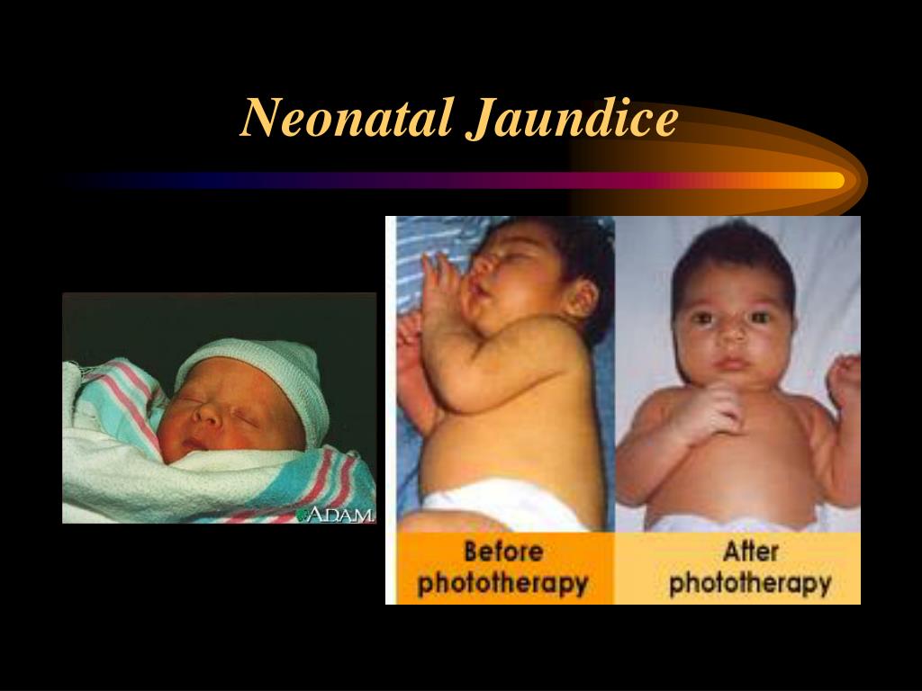 PPT - Neonatal Jaundice Hyperbilirubinemia PowerPoint Presentation ...