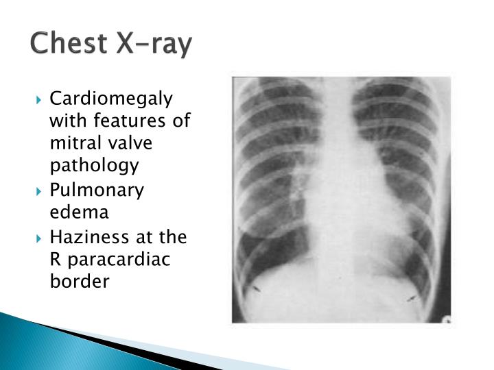 PPT - CASE 2: RHEUMATIC HEART DISEASE PowerPoint Presentation - ID:1945759