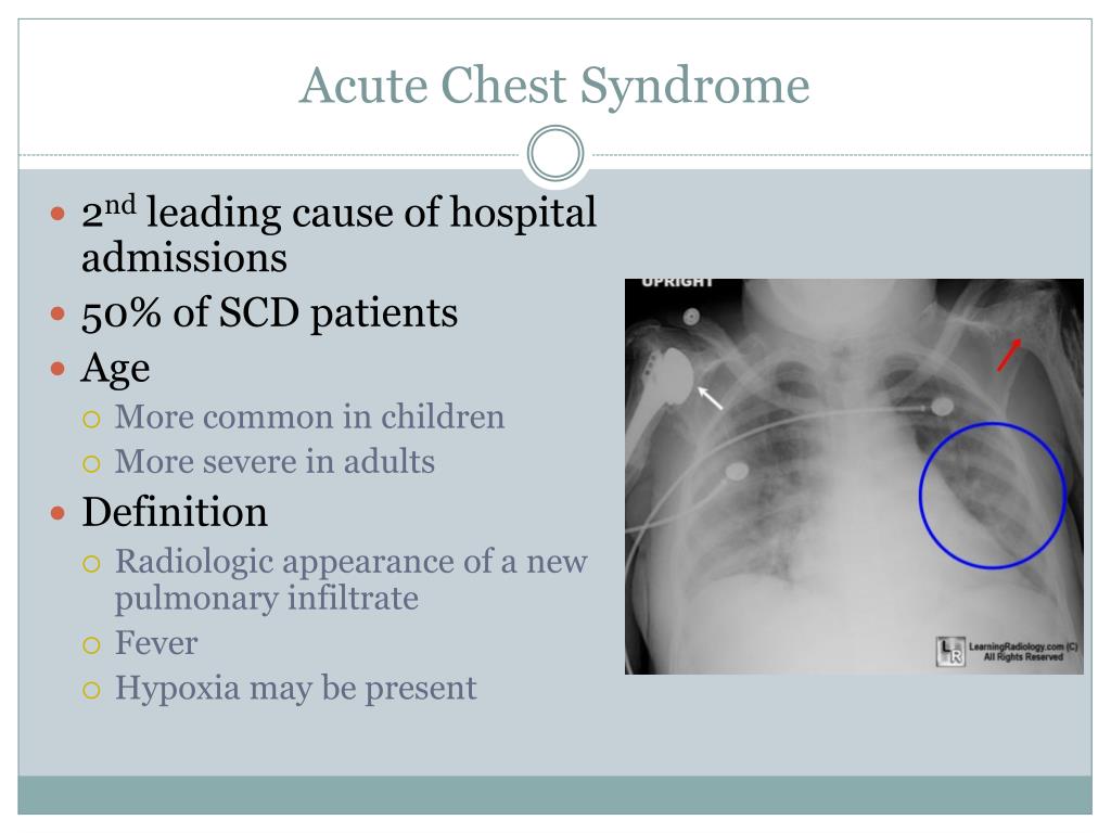 Pathophysiology Of Acute Chest Syndrome