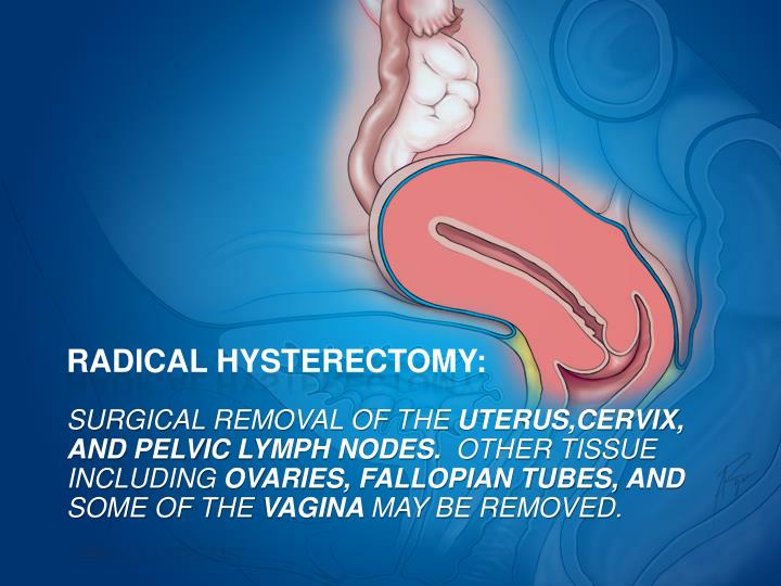 PPT - FOCUS: HYSTERECTOMY PowerPoint Presentation - ID:1977506