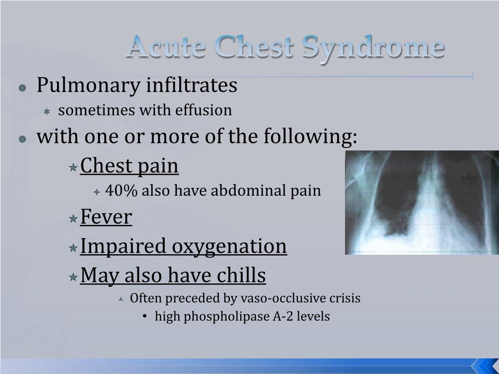 PPT - Pulmonary Complication Of Sickle Cell Disease PowerPoint ...