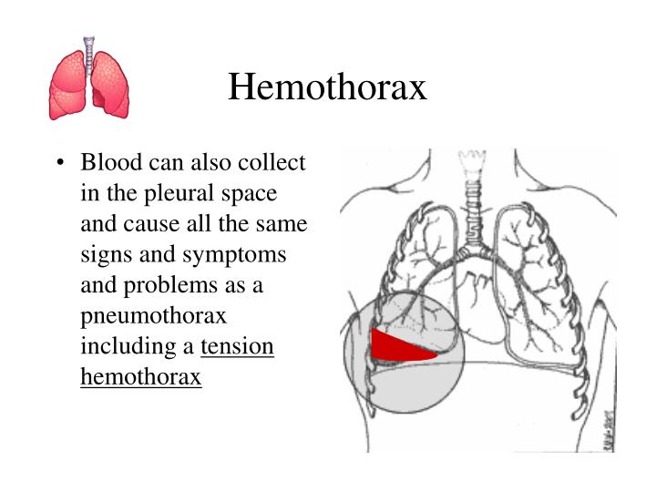 Hemothorax Causes Signs Symptoms Diagnosis Hemothorax | Sexiz Pix