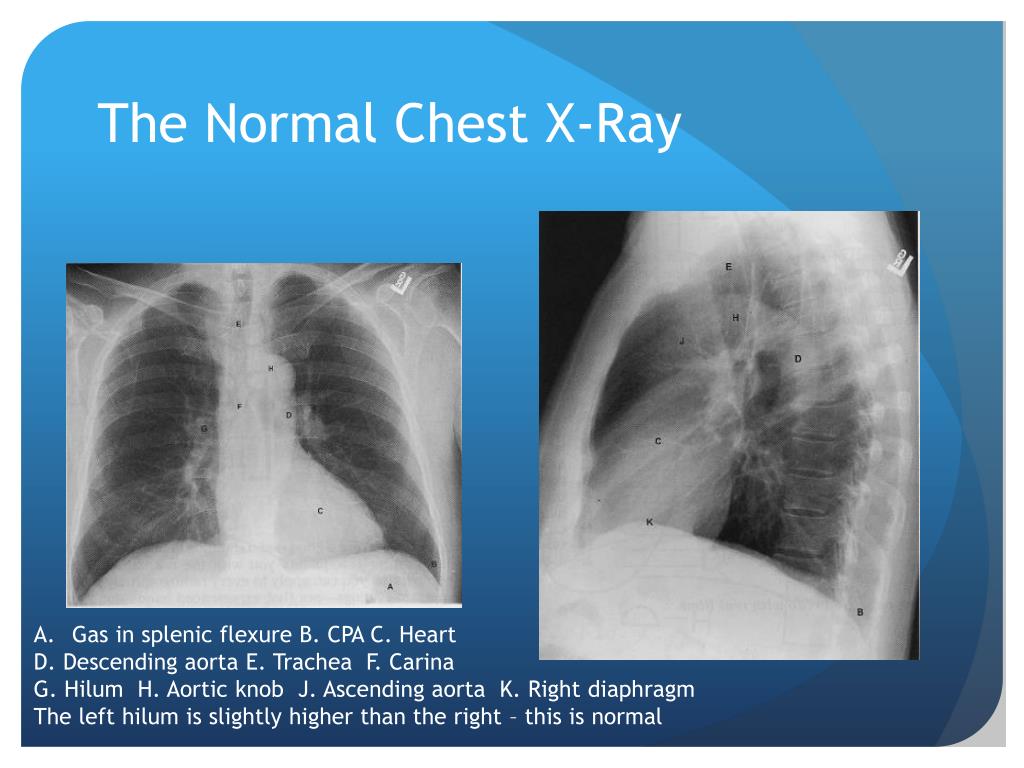 PPT - Chest X-Ray Interpretation for the Internist PowerPoint ...