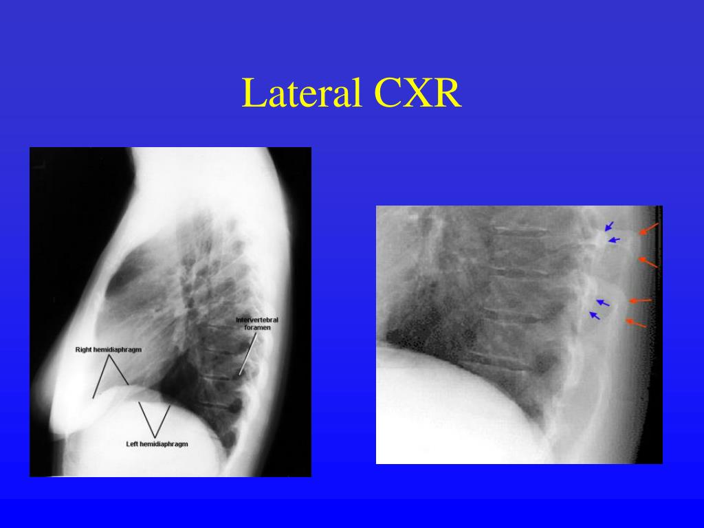 PPT - Reading the CXR PowerPoint Presentation, free download - ID:3651736