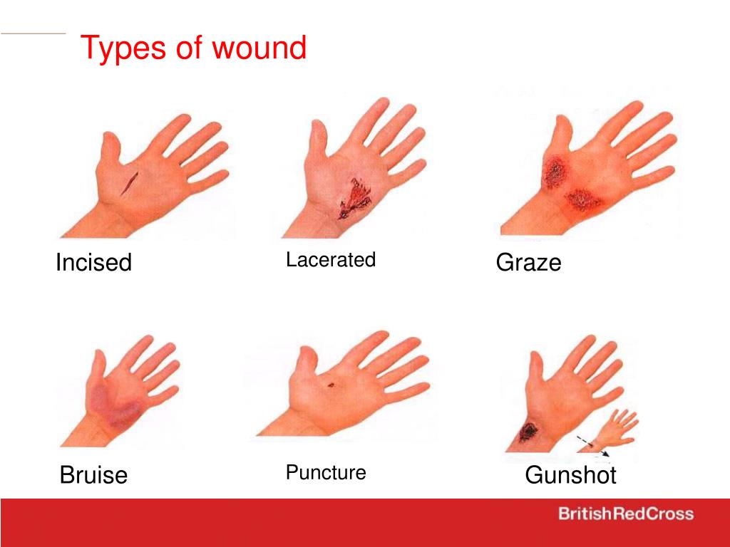 Types Of Wounds And First Aid Treatment at Albert Stallings blog