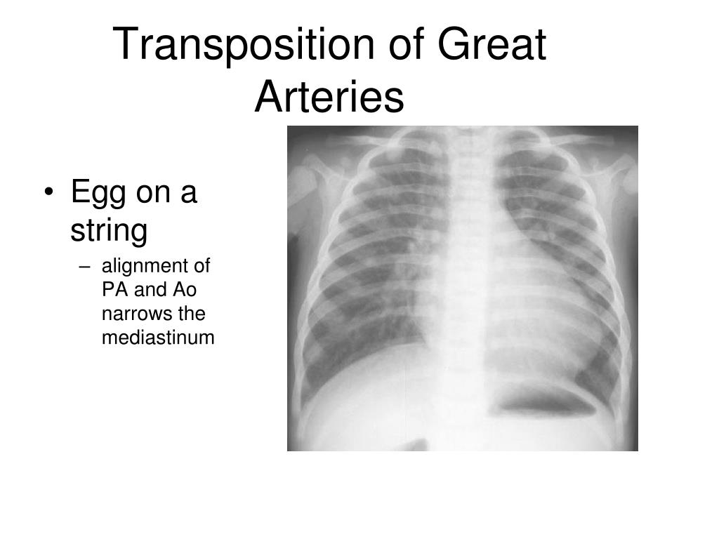 Transposition Of The Great Arteries X Ray