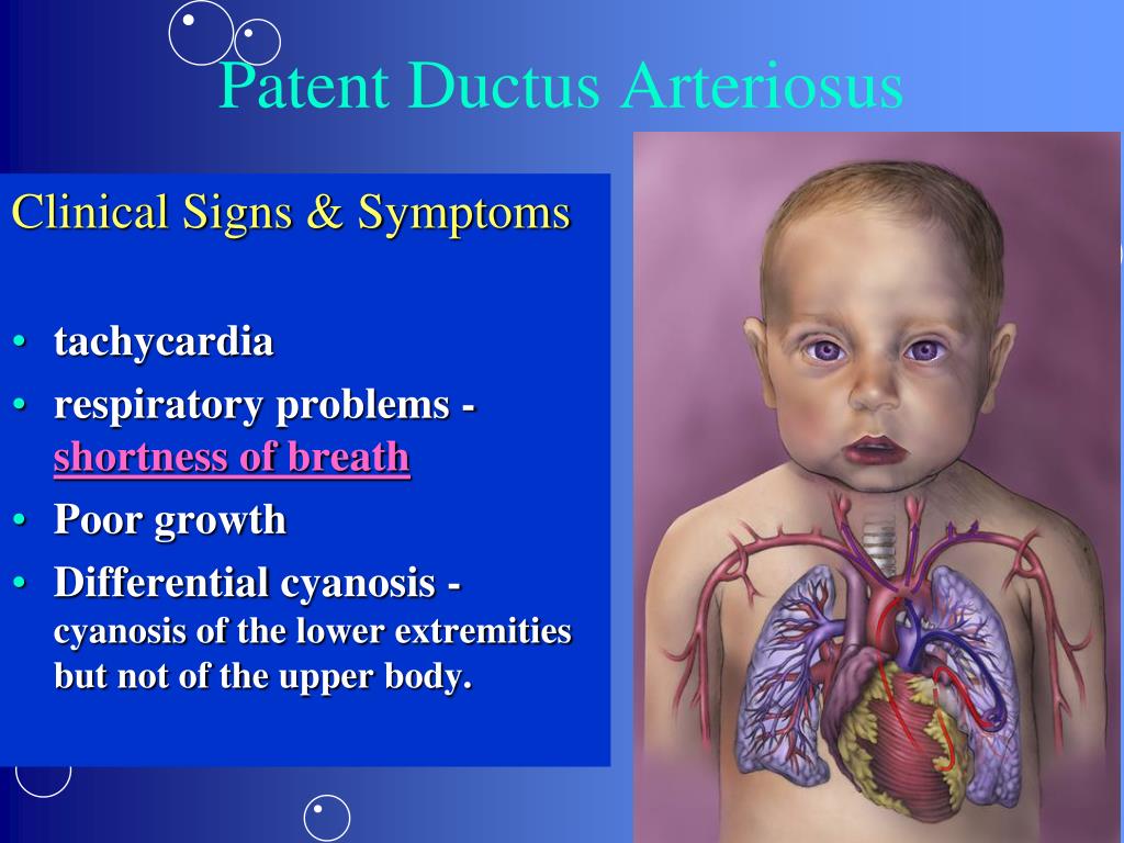 PPT - Congenital Heart Disease PowerPoint Presentation, free download ...