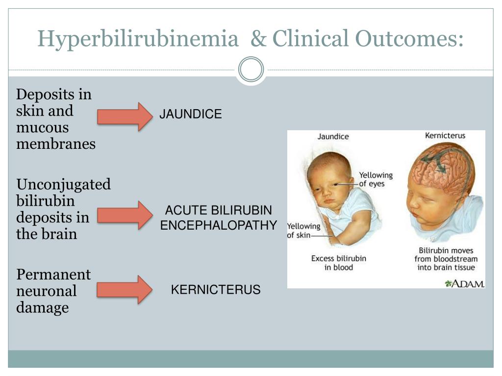 Neonatal Jaundice Symptoms Causes Treatment Santripty - vrogue.co