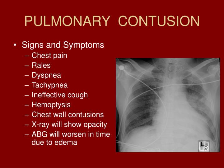 PPT - CHEST TRAUMA PowerPoint Presentation - ID:4611815