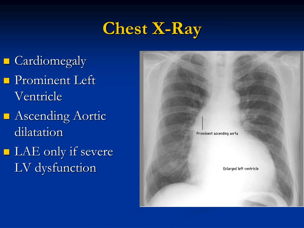 PPT - Aortic Regurgitation PowerPoint Presentation, free download - ID ...