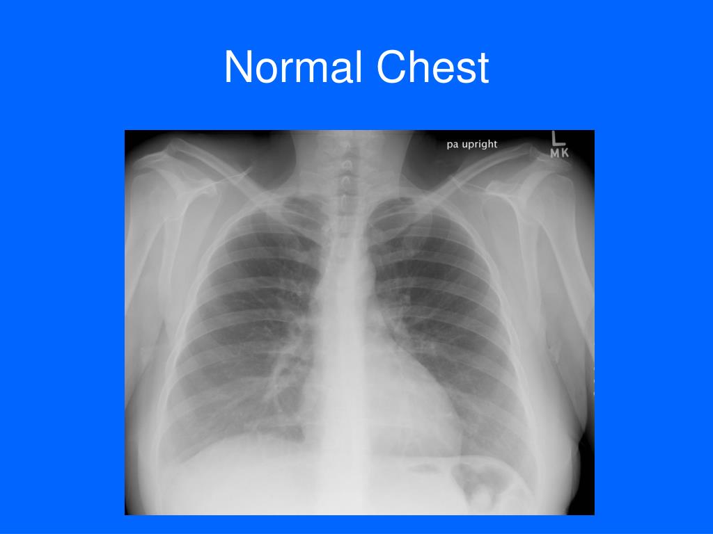 PPT - Chest Radiology Plain Film and CT- Beyond the Basics PowerPoint ...