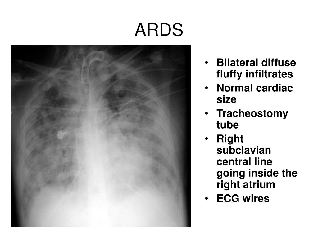 PPT - Tension hydropneumothorax PowerPoint Presentation, free download ...