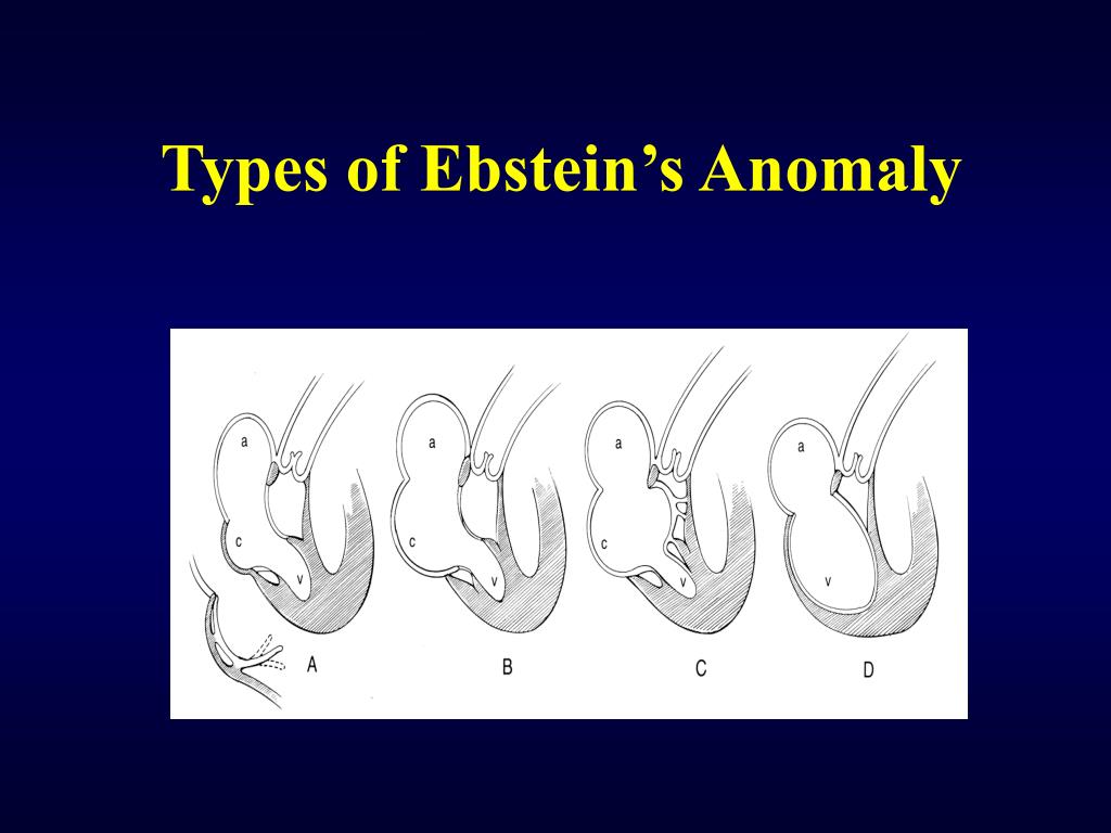 PPT - Ebstein’s Malformation PowerPoint Presentation, free download ...