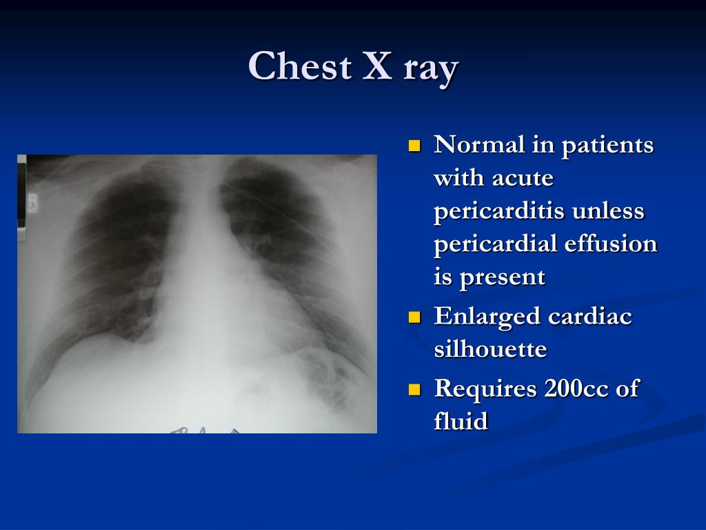 PPT - Acute Pericarditis and Pericardial Effusion PowerPoint ...