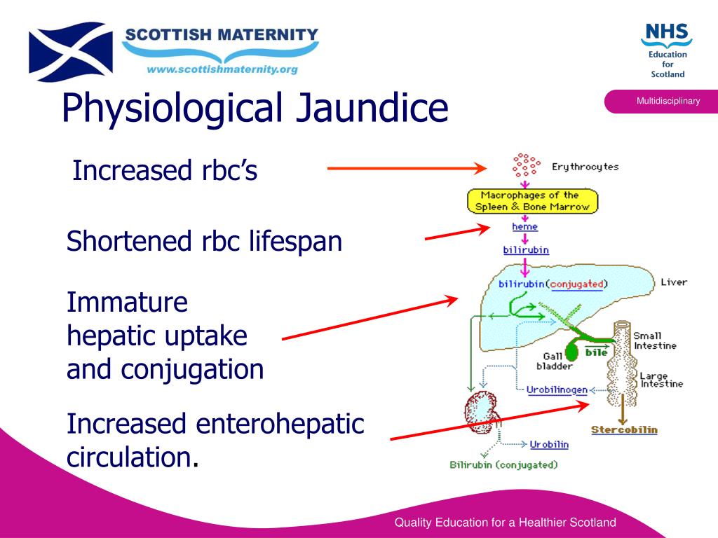 Physiologic Neonatal Jaundice Pathogenesis Calgary Gu - vrogue.co