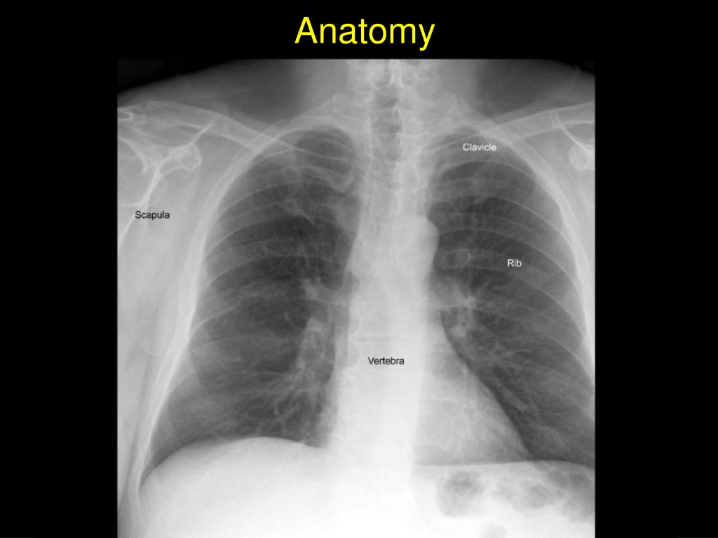 PPT - The Chest X-Ray PowerPoint Presentation, free download - ID:5750796