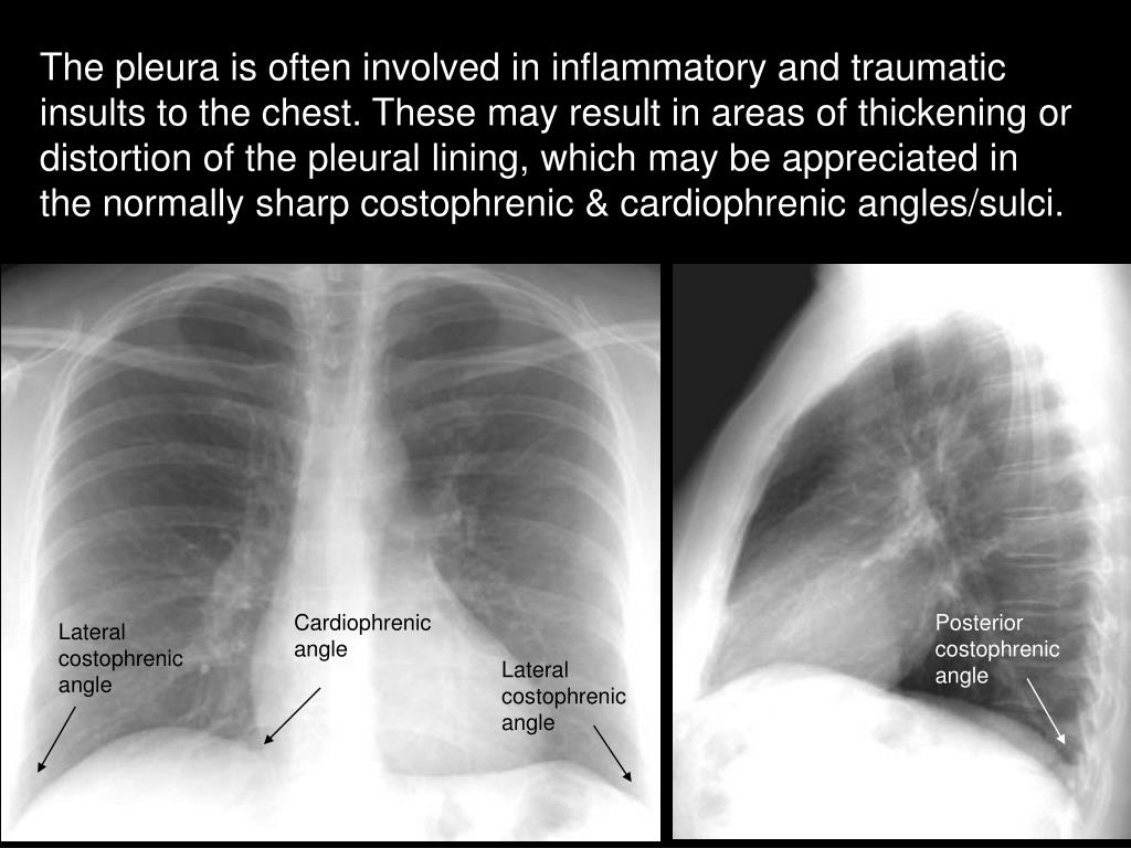 PPT - Thoracic Radiographic Anatomy PowerPoint Presentation, free ...