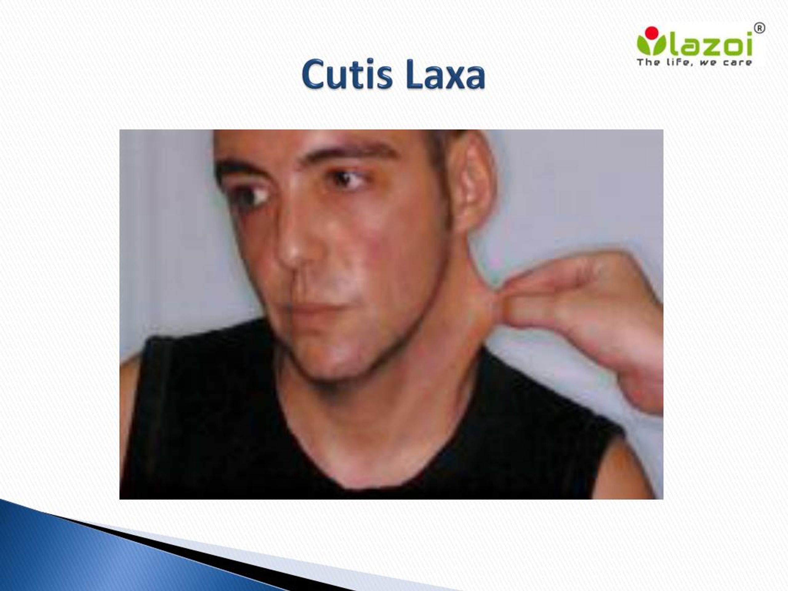 PPT - Cutis Laxa: Causes, Symptoms, Diagnosis and Treatment PowerPoint ...