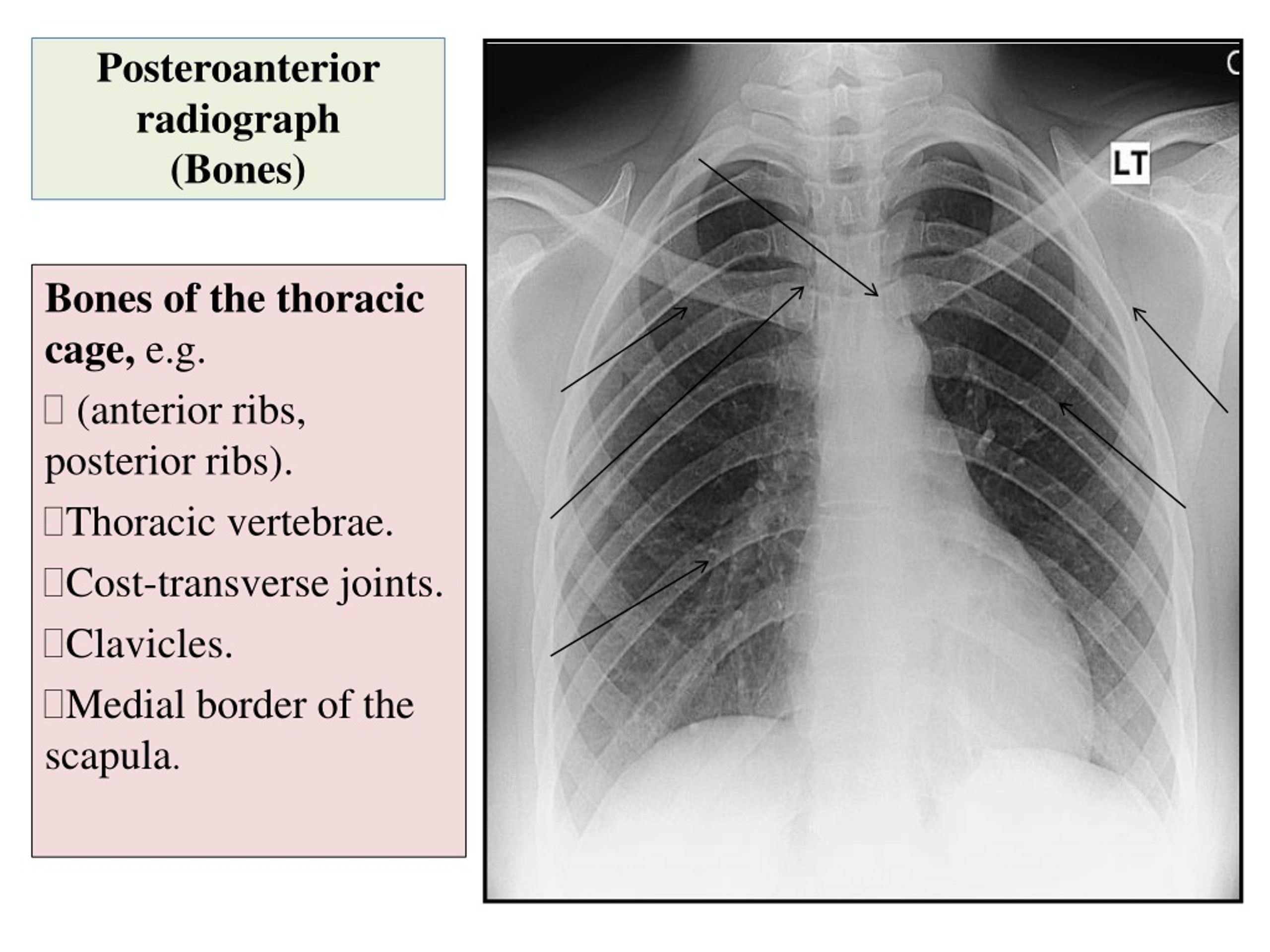 PPT - Radiological Anatomy Of The Chest PowerPoint Presentation, free ...