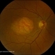 Central Areolar Choroidal Dystrophy