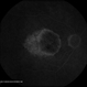 Central Areolar Choroidal Dystrophy