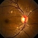 HIV Retinopathy