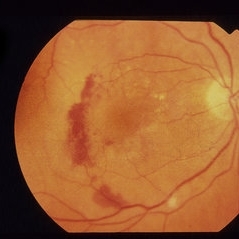 Choroidal Neovascularization With Subfoveal - Retina Image Bank