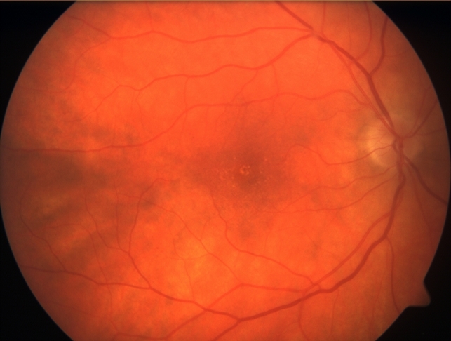 Mild VMT plus drusen - Retina Image Bank