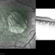 Central Areolar Choroidal Dystrophy