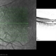 Central Areolar Choroidal Dystrophy