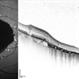 Geographic Atrophy 2nd to Central areolar choroidal dystrophy