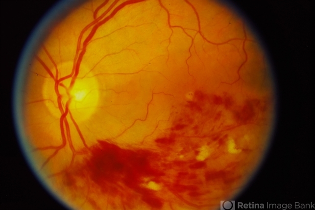 Branch Retinal Vein Occlusion (BRVO) - Retina Image Bank