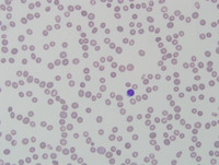 Aplastic Anemia and Paroxysmal Nocturnal Hemoglobinuria PB higher power