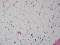 Aplastic Anemia and Paroxysmal Nocturnal Hemoglobinuria Biopsy