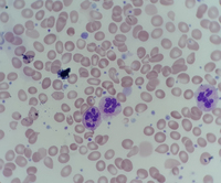 Neutrophil hyper-segmentation in JAK2 positive case