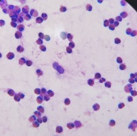 Eosinophils in nasal smear