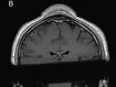 An MRI of a breaker&#x27;s head shows the tumor that doctors believe developed due to repeated headspins. BMJ Case Reports 2024