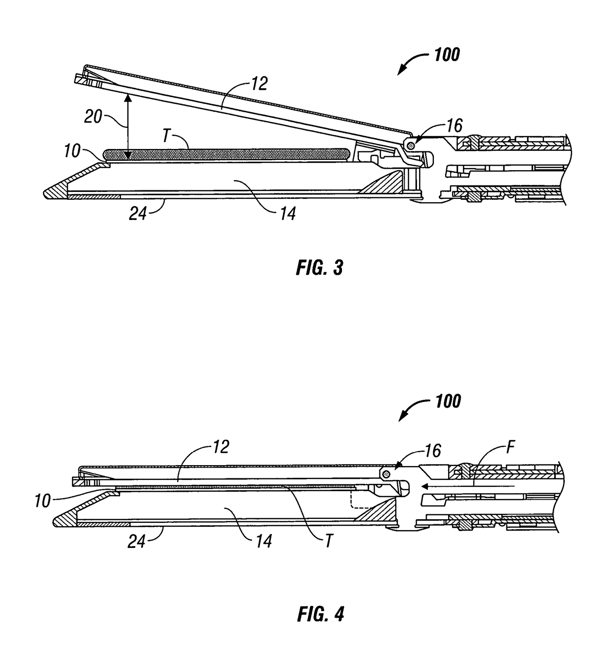 Mechanically tuned buttress material to assist with proper formation of surgical element in diseased tissue