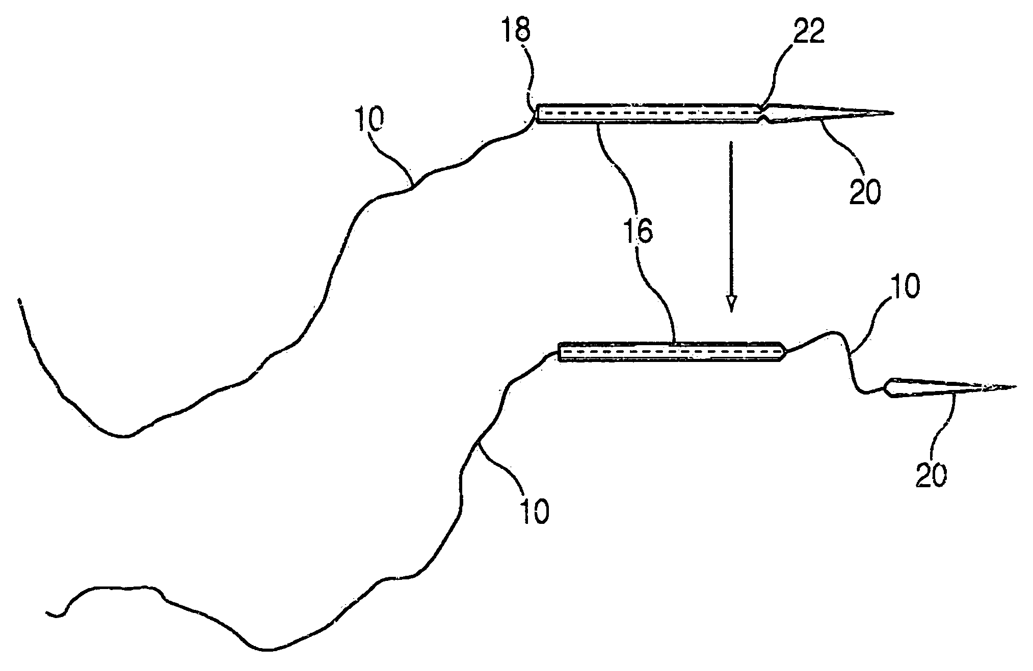 Suture passer and method of passing suture material