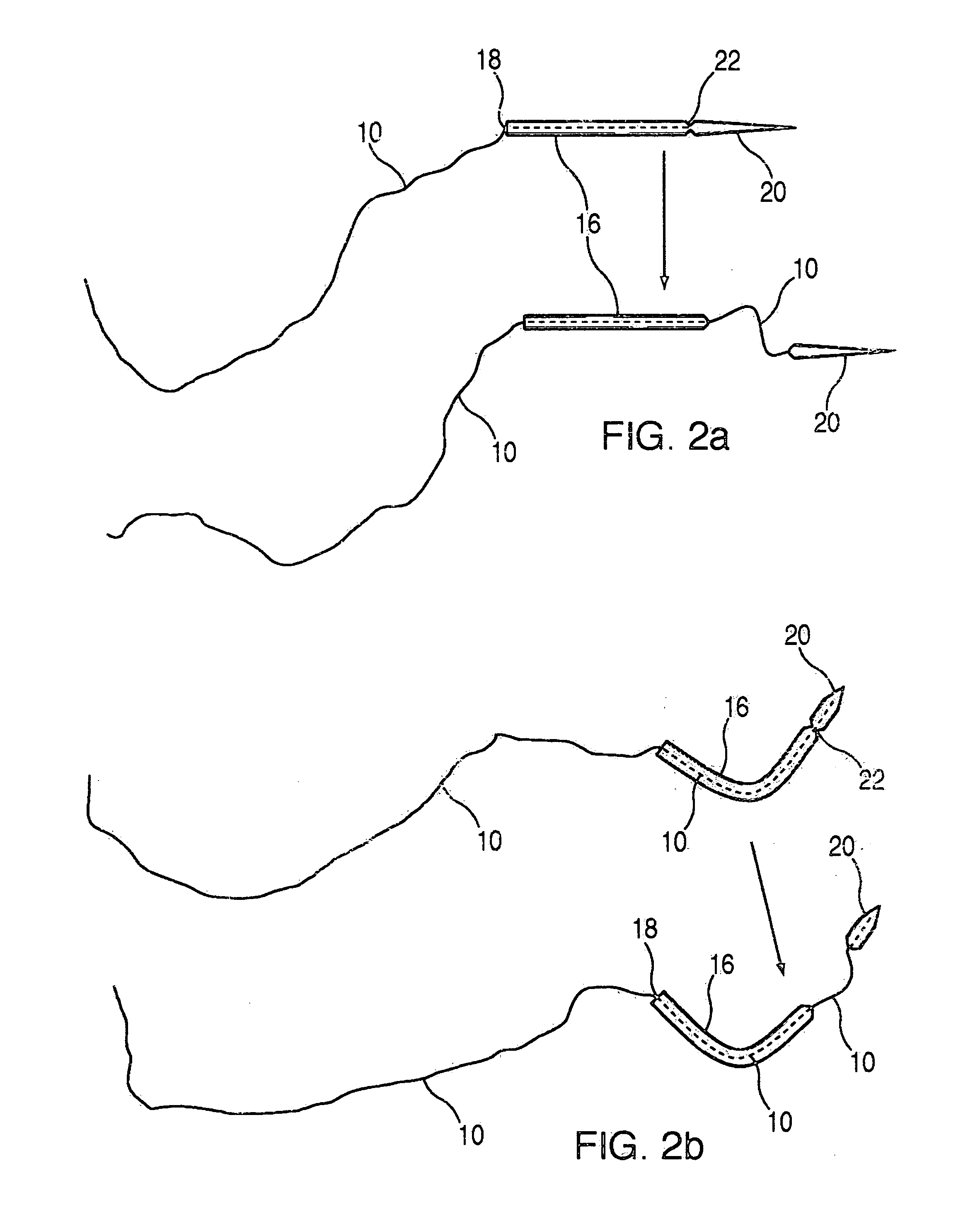 Suture passer and method of passing suture material