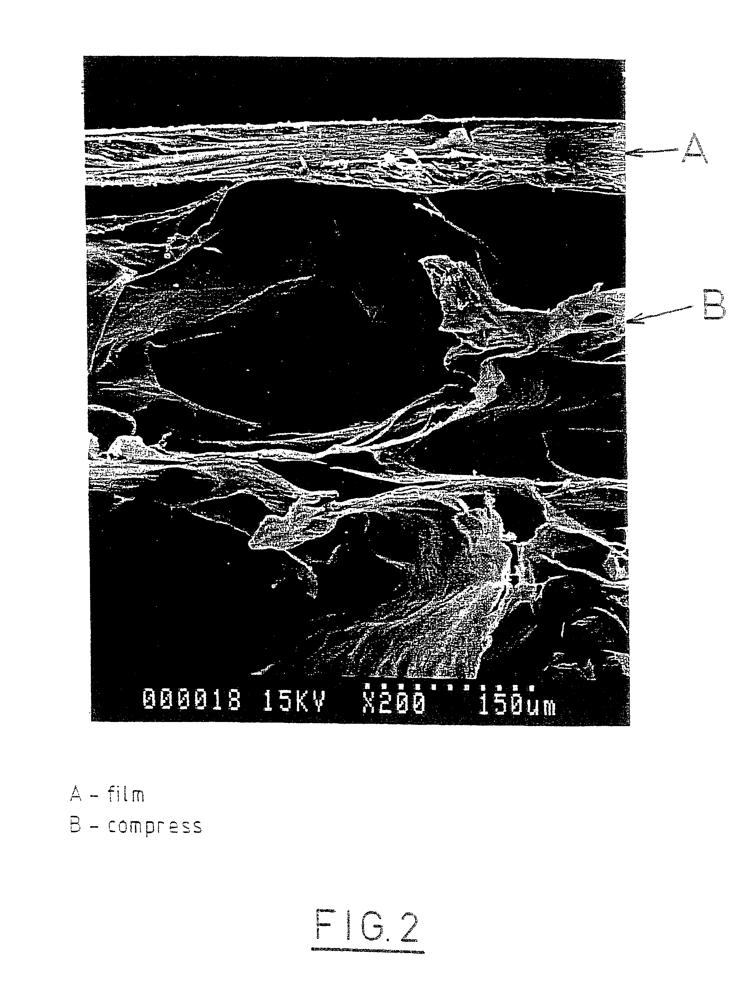 Method for preparing two-layer bicomposite collagen material for preventing post-operative adhesions