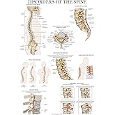 Palace Learning Disorders of the Spine Anatomy Poster – Tabla anatómica de trastornos espinales laminados – 18 x 24 pulgadas