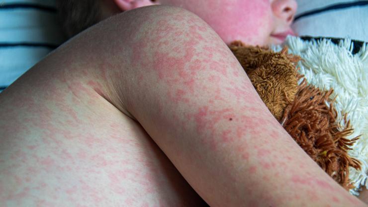 Measles have been detected in Victoria.