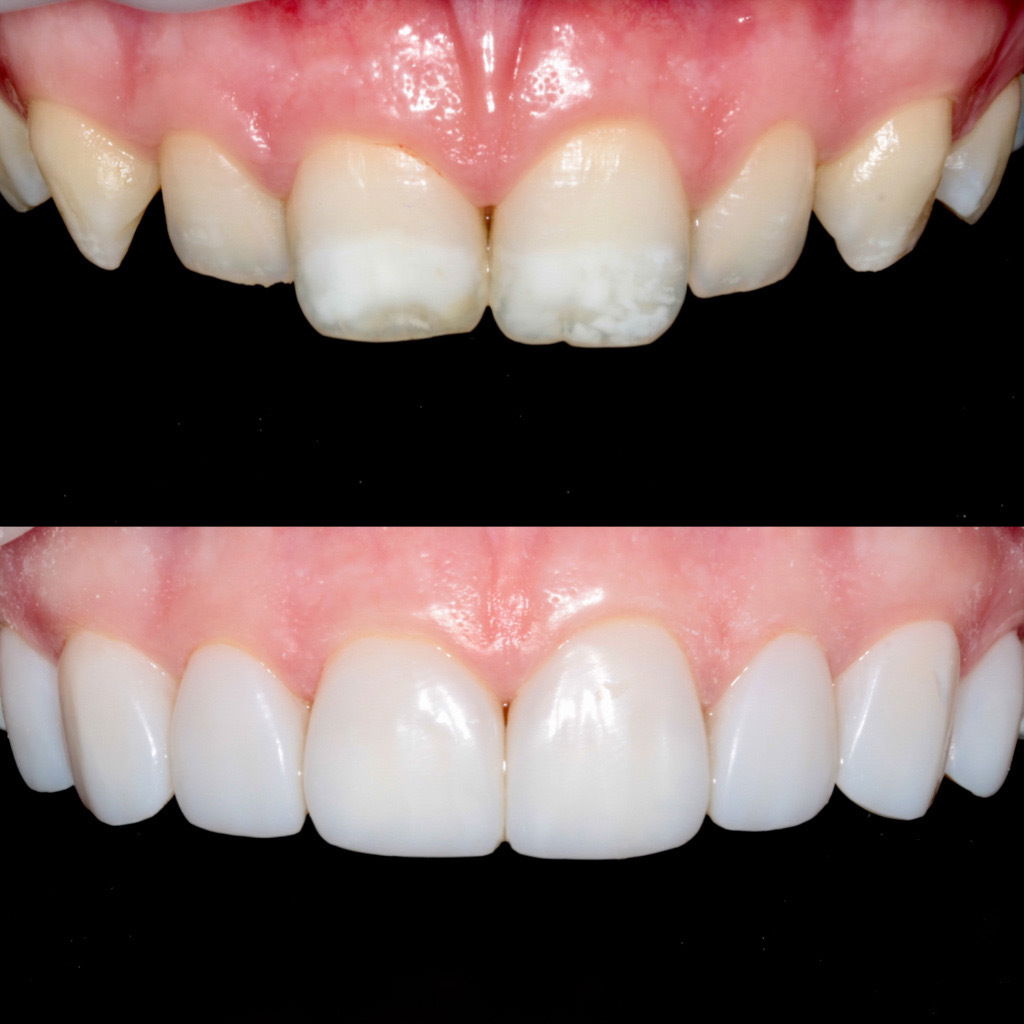 Composite Veneers