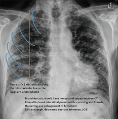 Met 2: Lung Rad 2 Flashcards - Cram.com